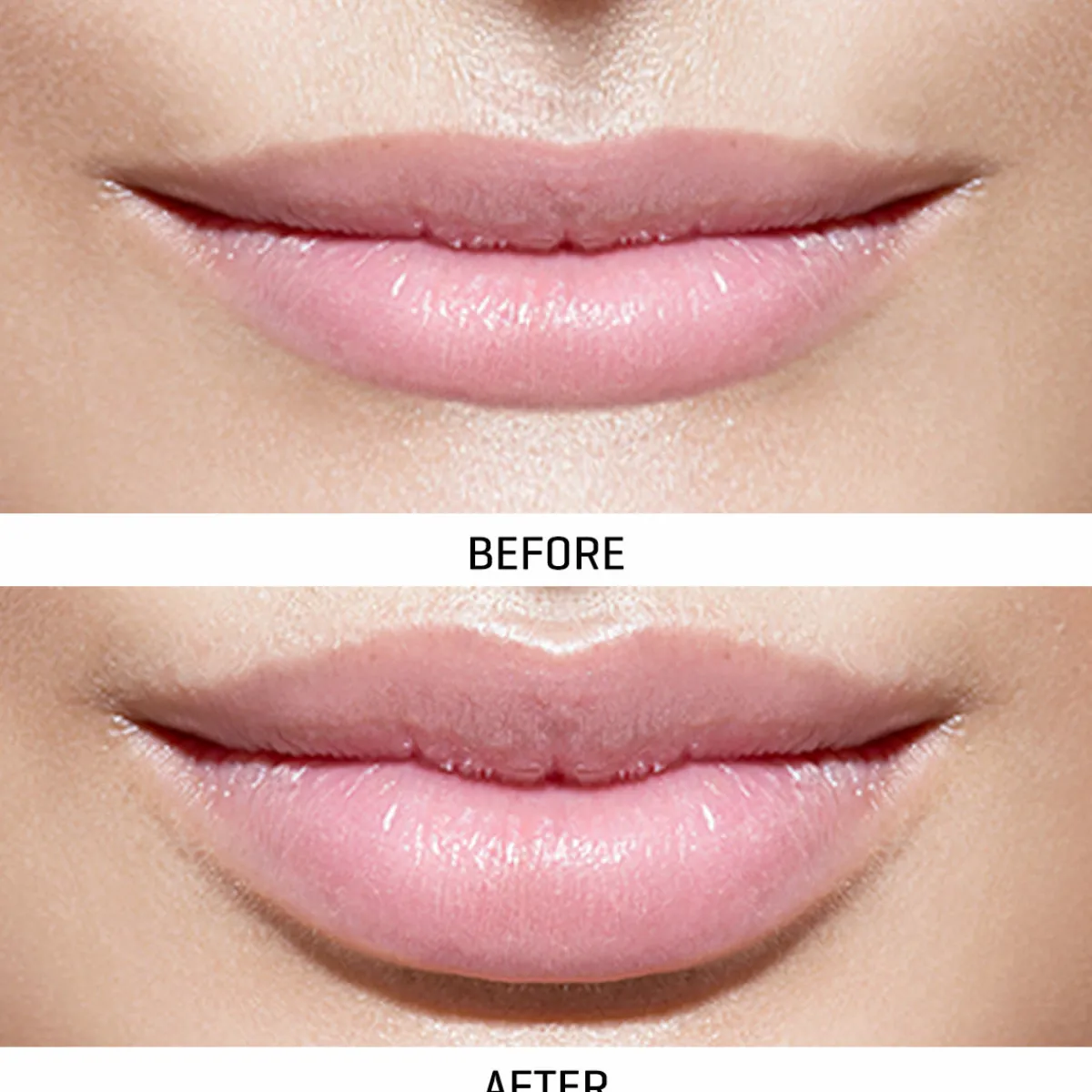 Prospera Corporation World's First At-Home Professional LED Lip Therapy Device